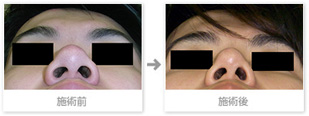 症例写真：鼻尖縮小術（コンプリートリダクション法）プラス鼻骨幅寄せ術3