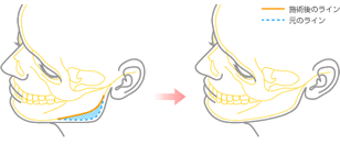 図：下顎骨角部切除法