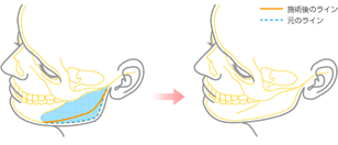 図：下顎骨体部削除法＋下顎骨角部切除法